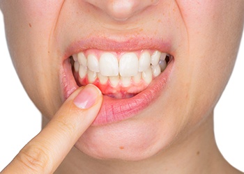 Woman with inflamed gums