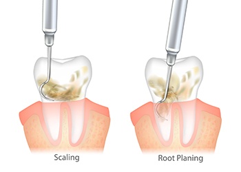 Scaling and root planing image